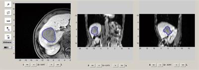 Radiomics nomogram for prediction of microvascular invasion in hepatocellular carcinoma based on MR imaging with Gd-EOB-DTPA